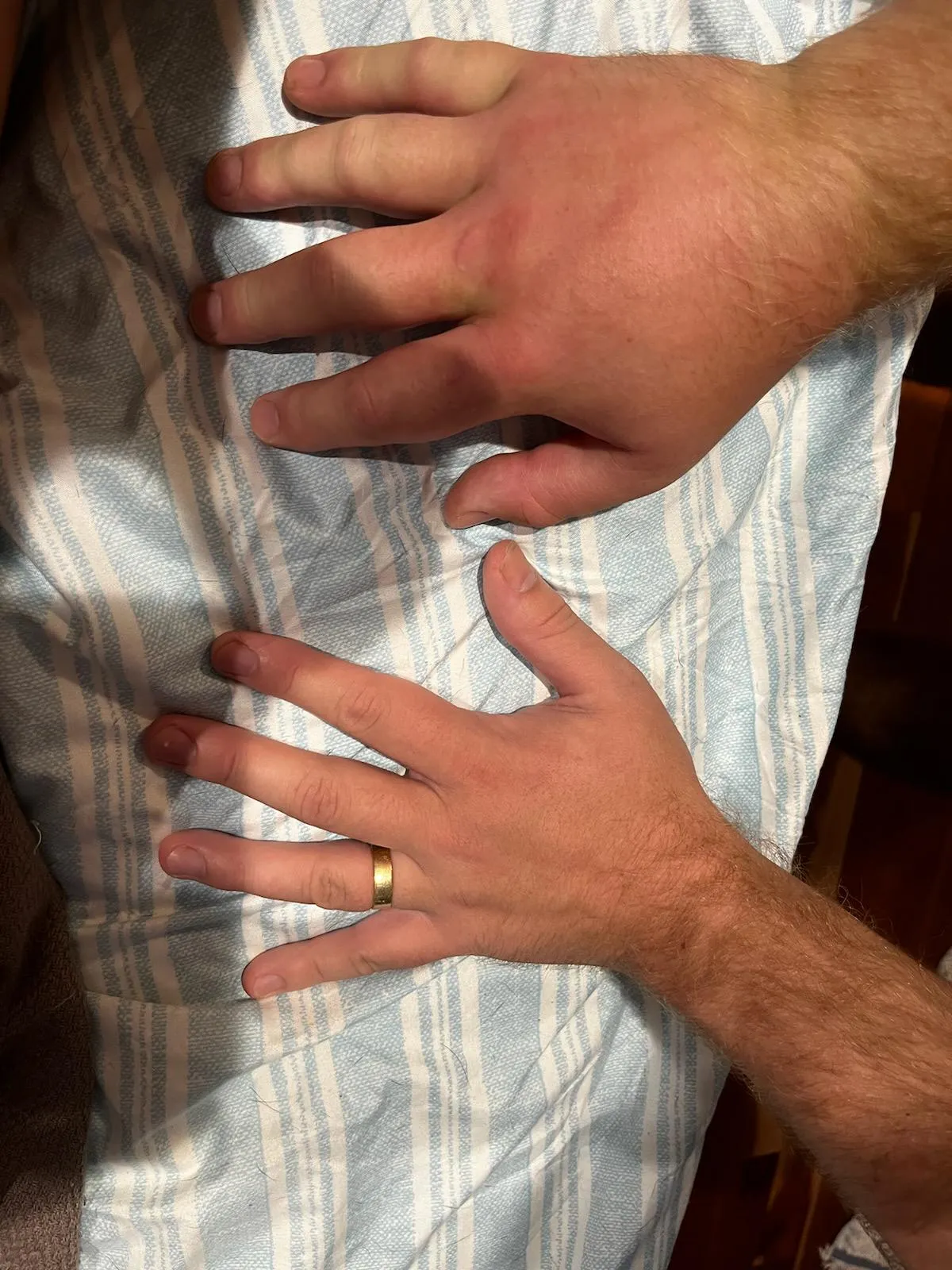 24 hours after being stung by a yellow jacket on my middle upper knuckle