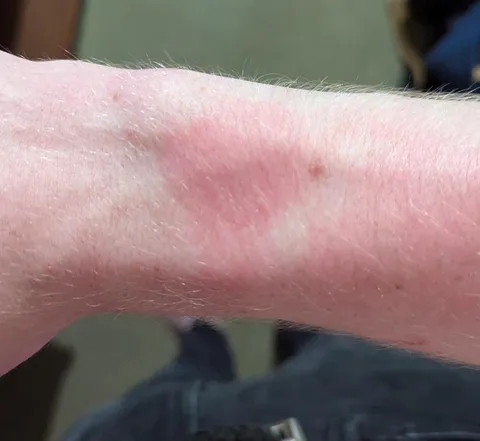 Where I normally wear my watch got sunburned more than the area around it