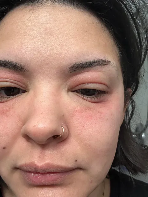 Watch my eyes blow up from the arnica in my concealer