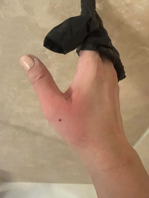 Just a reminder how serious cat bites can be!