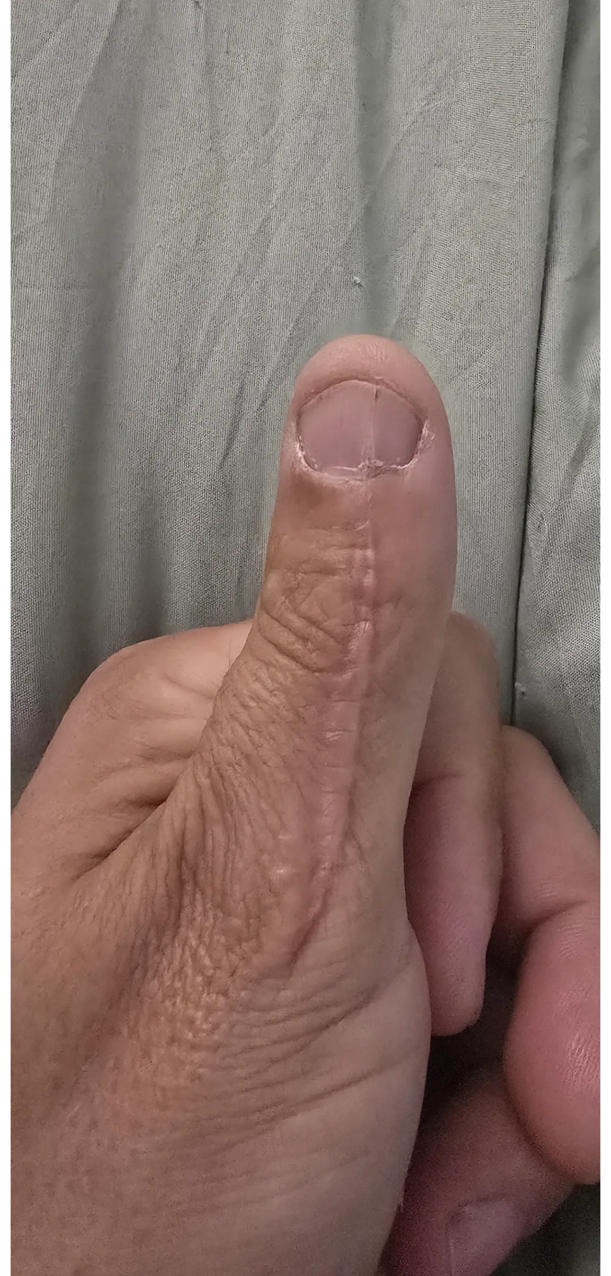 My thumb, 20 months after I cut it with a utility knife.