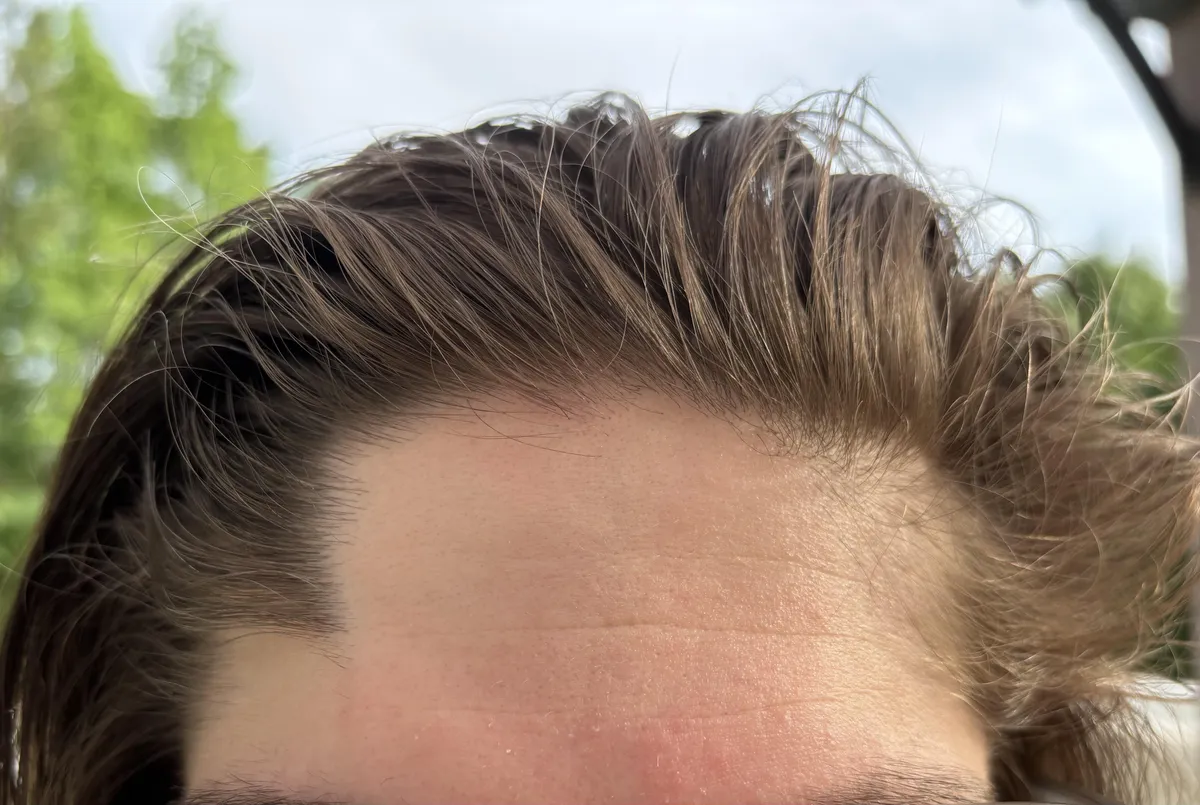My boyfriend’s weird hairline