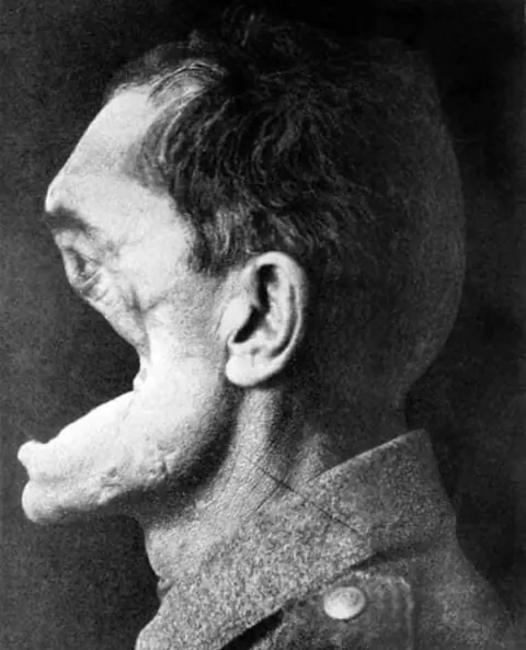 This is a photograph of a German Soldier whose face was severely disfigured by artillery fire during World War I.