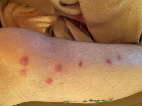 My mosquito bites looks like a mirrored Big Dipper