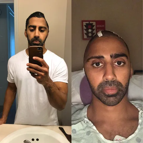 After sitting in a hospital freezer for a month and a half, a large section of my skull has been reattached.