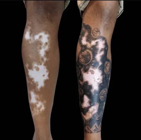 Turning vitiligo disease to an art