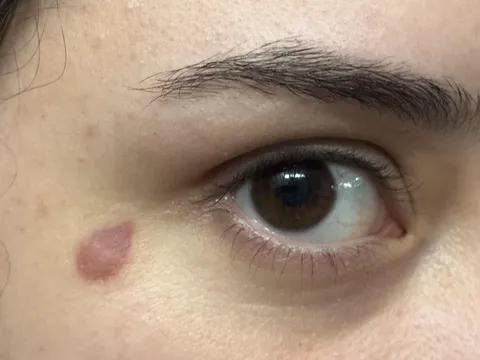 my bug bite looks like a teardrop tattoo