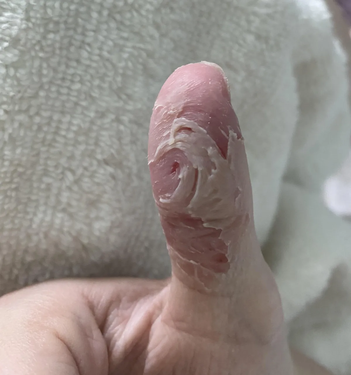 I have dermatillomania, this is what my thumb looks like straight out of a shower
