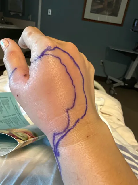 Just a reminder how serious cat bites can be!