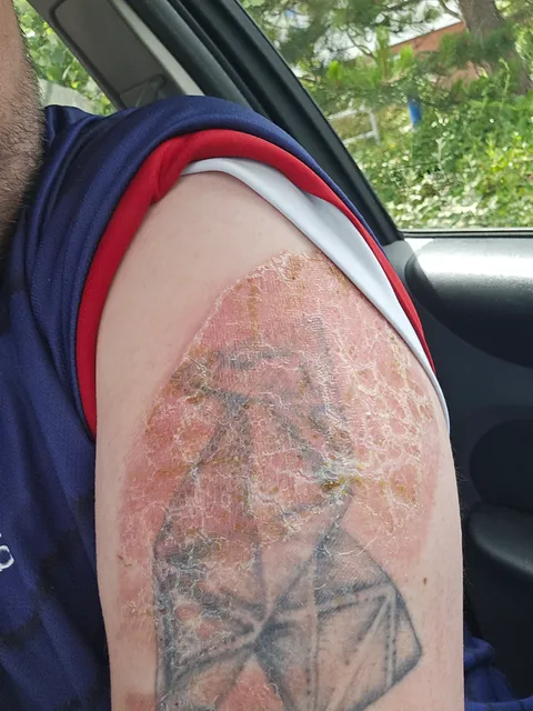 The urge to scratch and shred this dead/dry skin is immeasurable!!