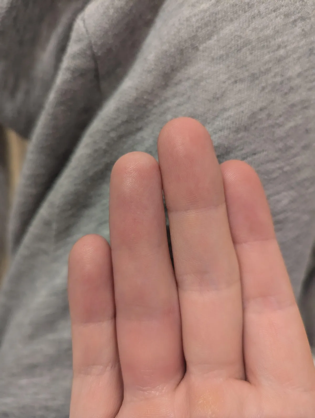 I broke my ring finger and after not bending it for a while I'm losing my crease on the top joint