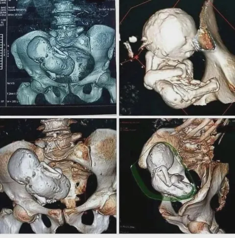 This xray of a woman shows a 30 year old calcified fetus.