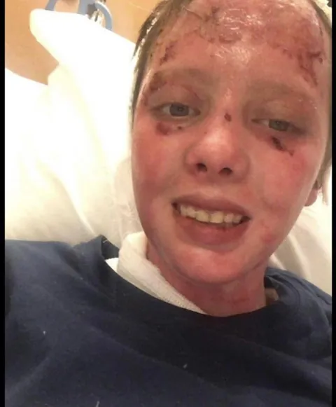 Almost 6 years post burn!!