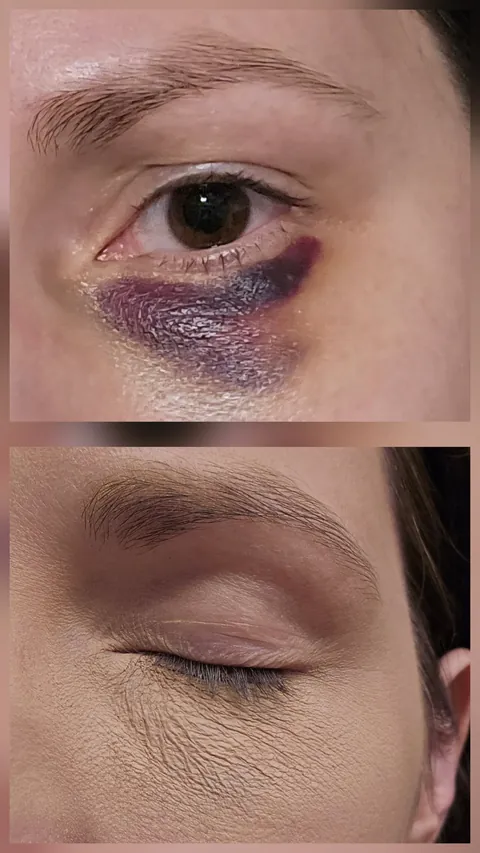 Help me cover my black eye for my job interview, please!