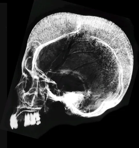 Skull in beta-thalassemia.