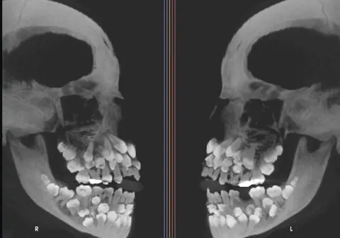 An x-ray of a patient with hyperdontia (the condition of having more teeth than average). Usually adults have 32 teeth. This person had 81.