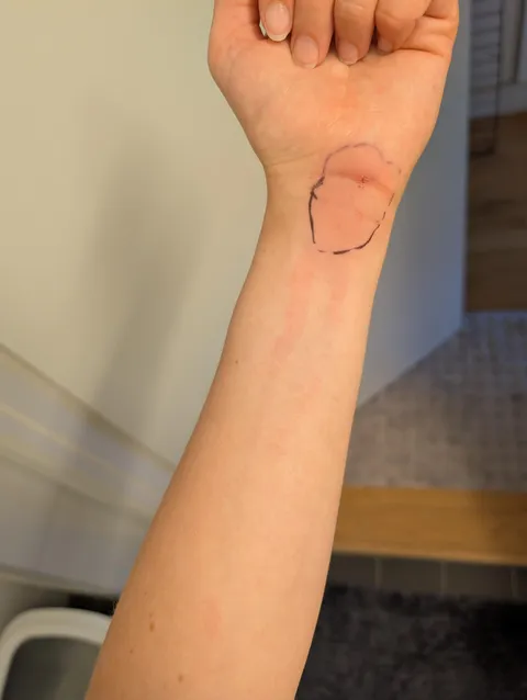 My infection looks like it's dripping down my arm