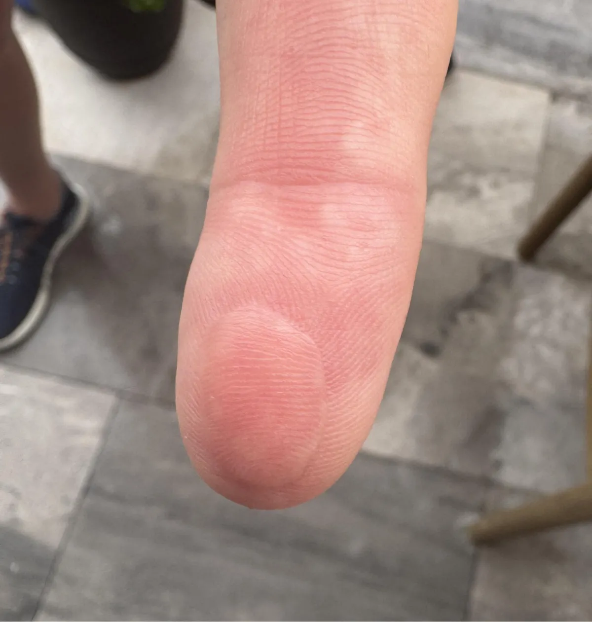 Uncle severed the pad off his index finger. Doctor sutured it on upside down