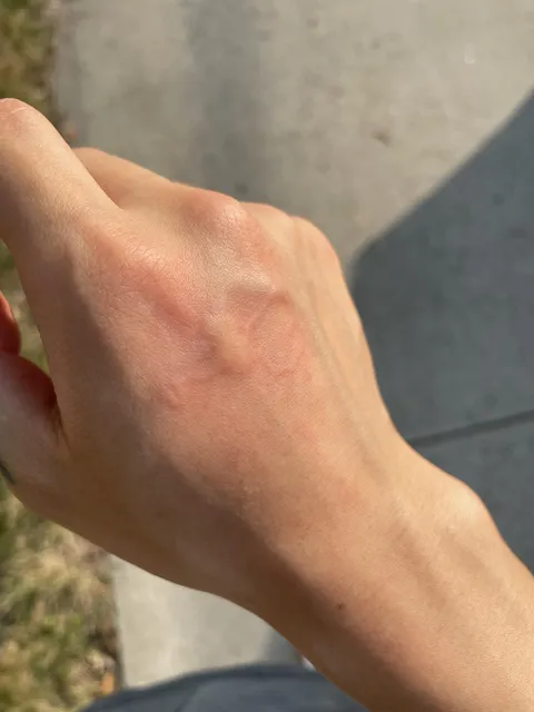 Weird mosquito bite