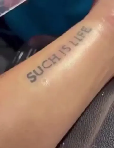 Q-switch lazer tattoo removal