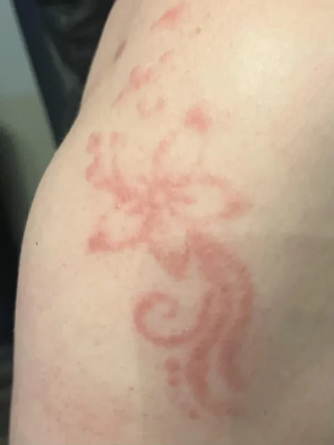My girlfriends allergic reaction to henna(appeared a month later)