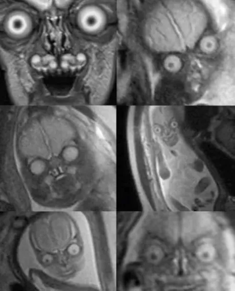PsBattle: MRI of baby in womb