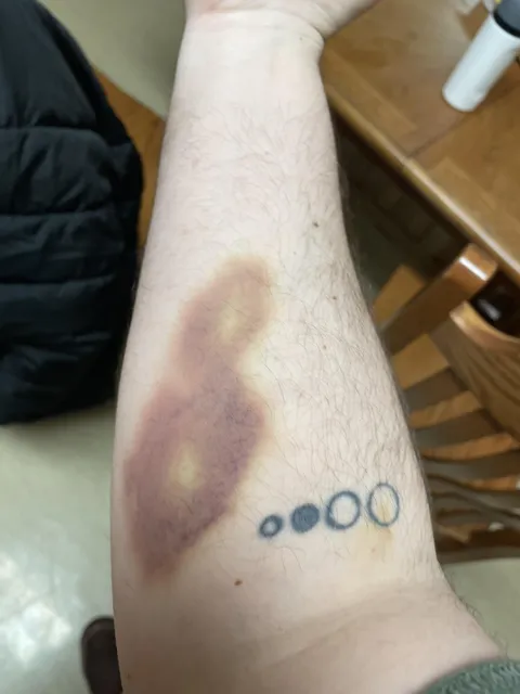 My "Cool S" shaped bruise