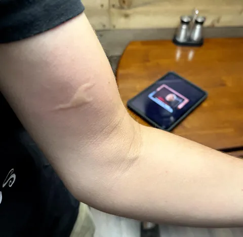 Strangest mosquito bite I’ve every had.