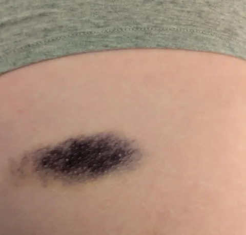 my girlfriend's bruises always turn almost fully black
