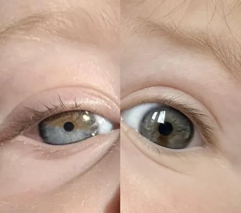 Both my children have sectorial Heterochromia