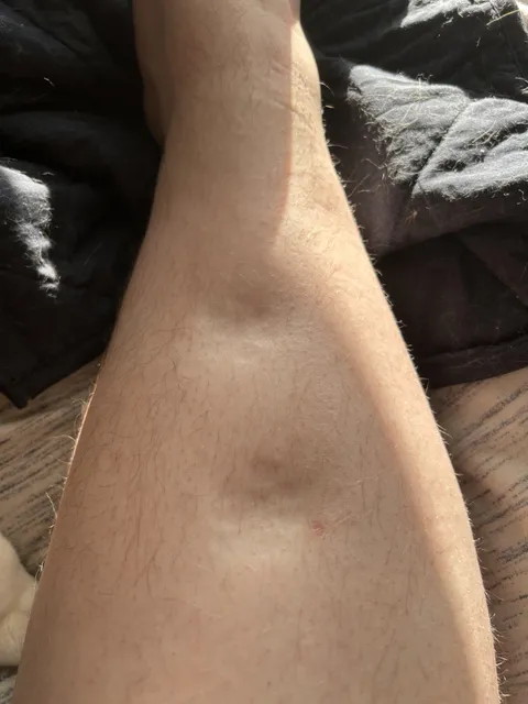 My cat stood on my leg and left paw imprints