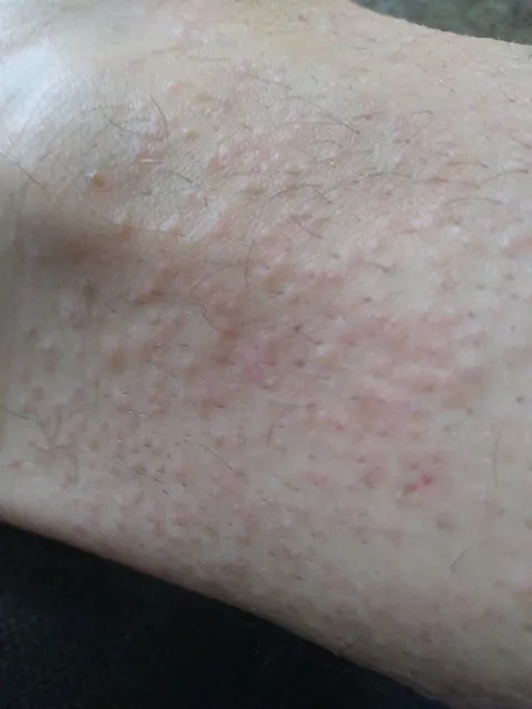 Landlord said the flea infestation was handled before we moved in, it wasn't 