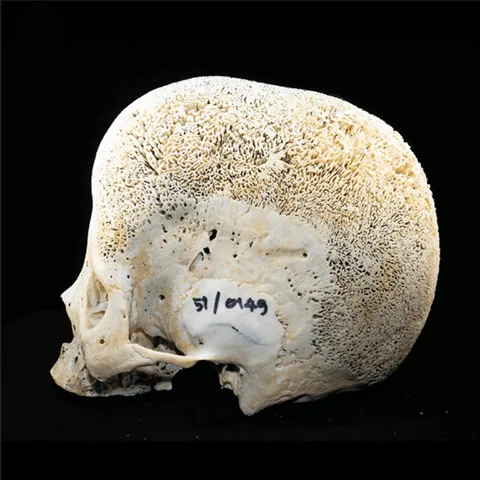 Skull in beta-thalassemia.