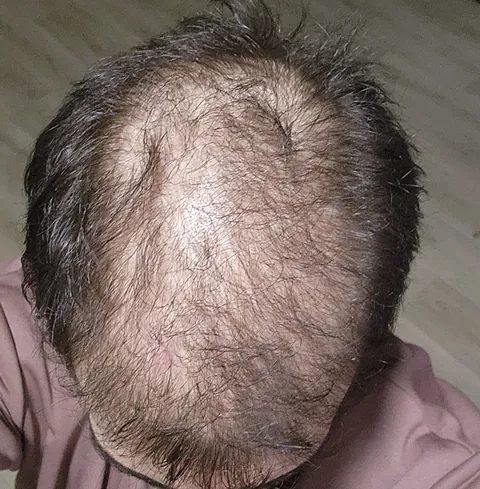 Losing hair as a teen - it's killing my confidence.