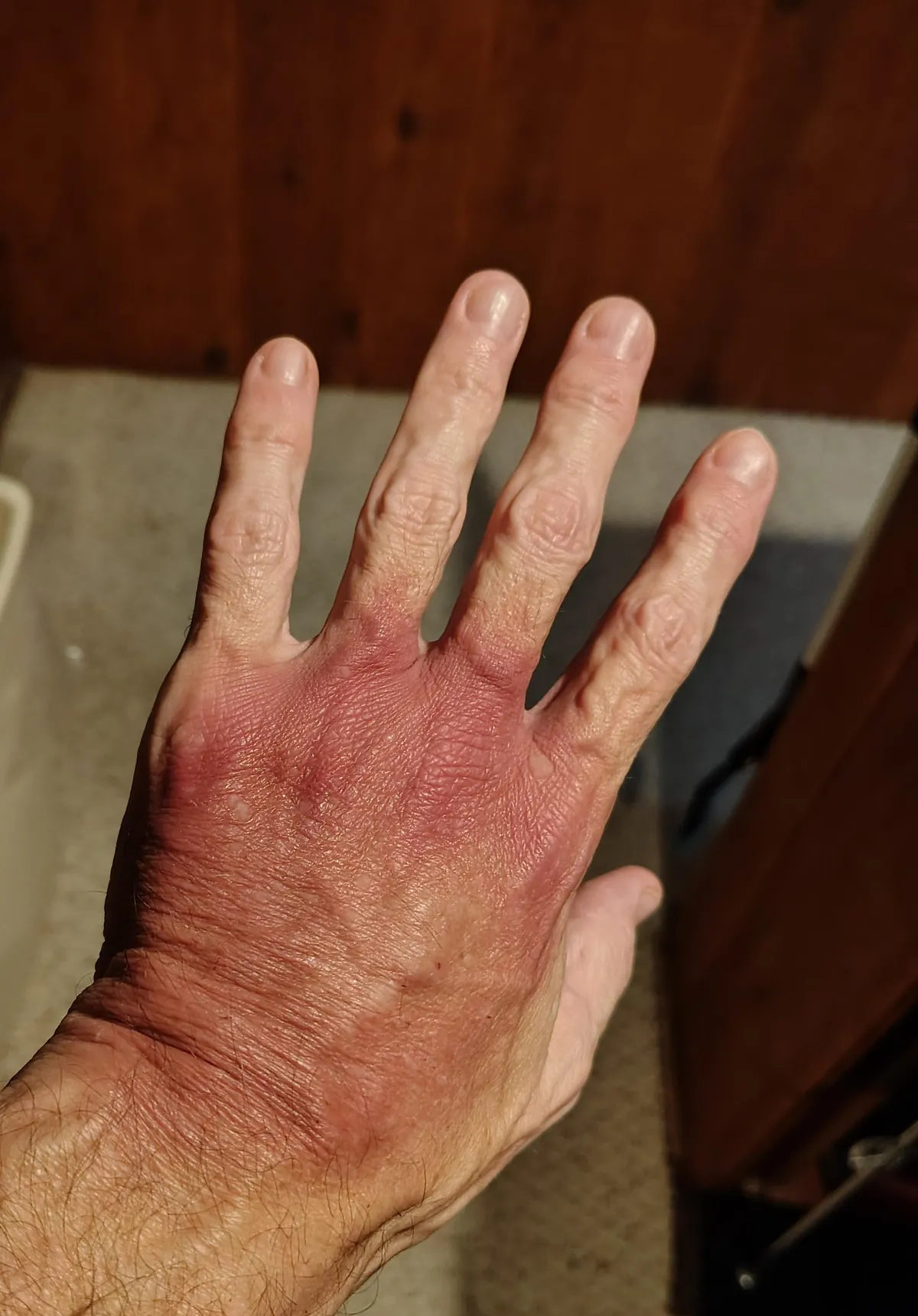 The IV bruise on my hand 4 days after surgery.