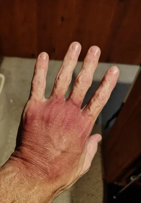 The IV bruise on my hand 4 days after surgery.