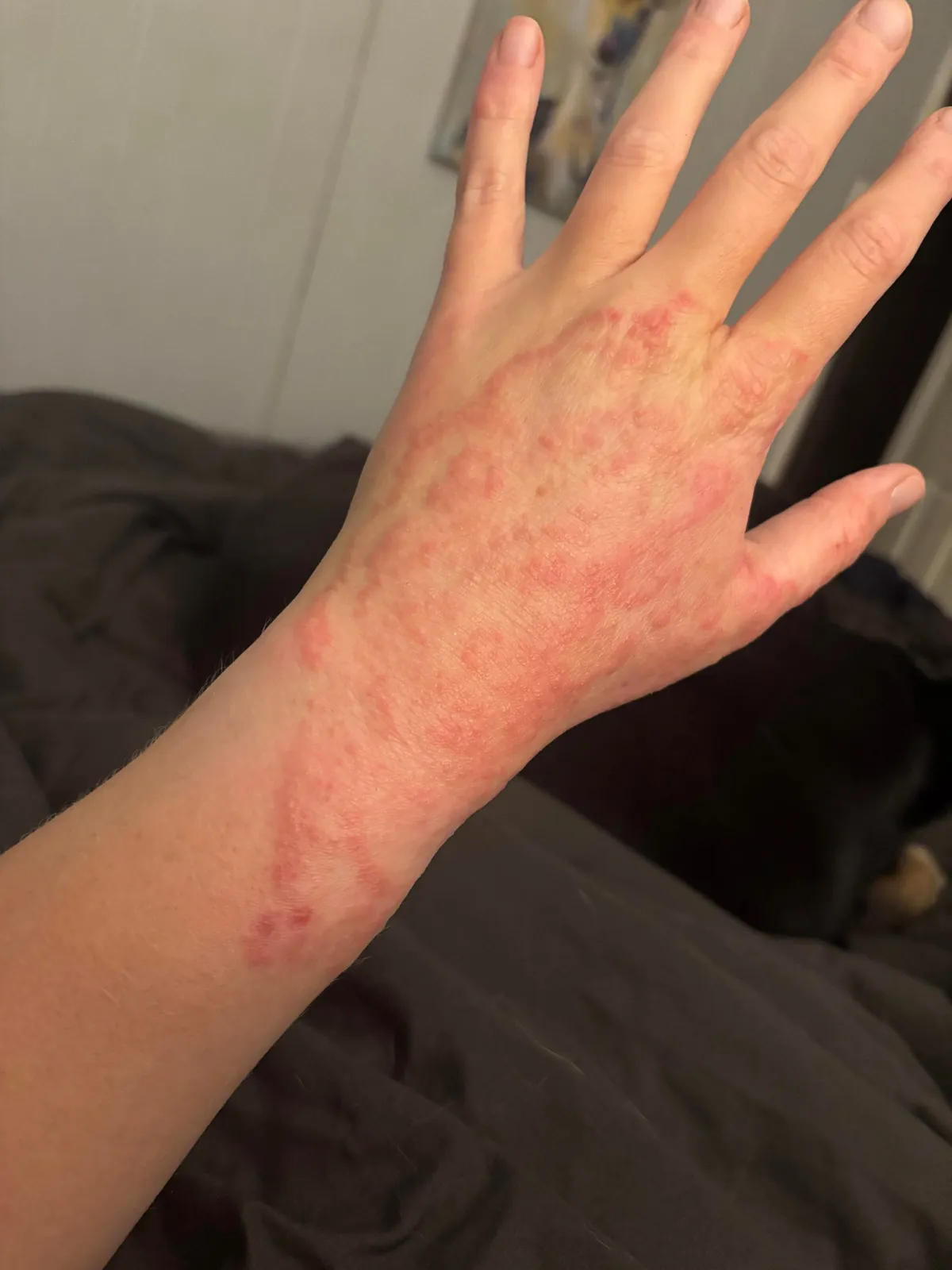 My inflamed hand. Has been this way since the spring