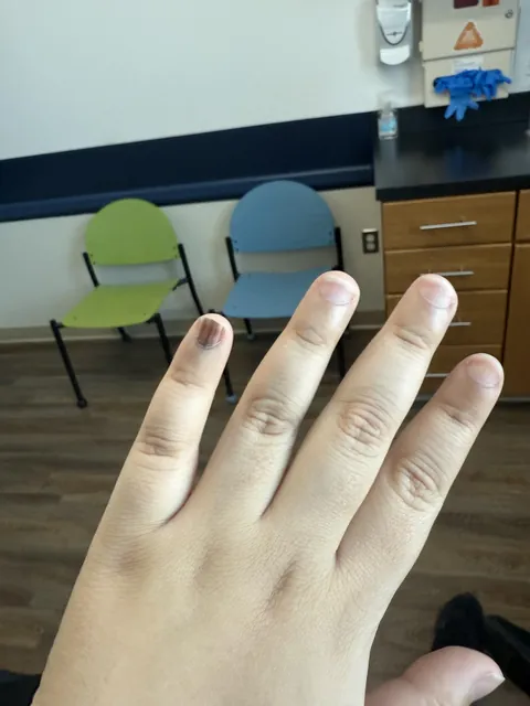 These weird lines / streaks I’ve had on my pinky nail for 8 years that two different doctors told me were due to vitamin deficiencies actually turned out to be a rare form of skin cancer.