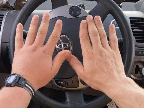 A Deer fly bit my left hand and made it look portly