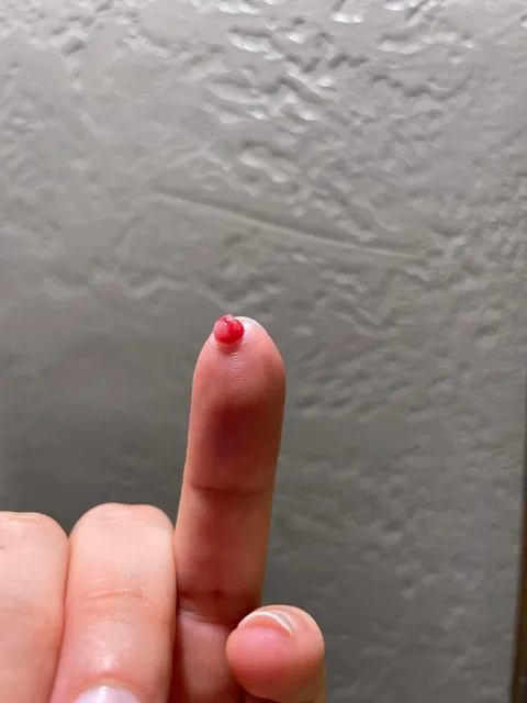 A blood blister on my fingertip popped, now I have a lump of flesh protruding through the hole.