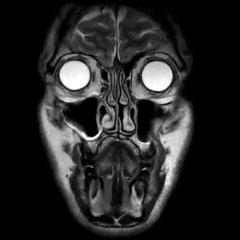 So I had an MRI last week and, kinda scary.