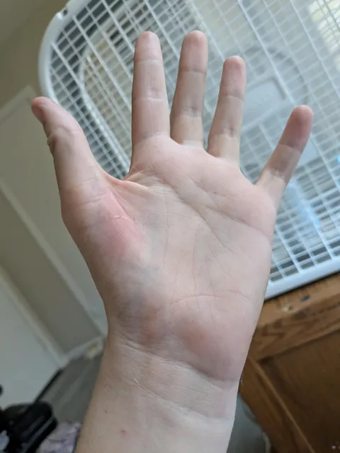 My hand doesn't have the pad of muscle below the thumb that most people have