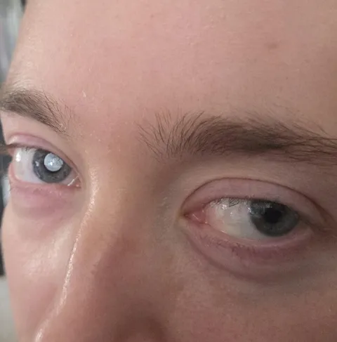 Got the perfect shot of my wife's artificial lens from her cataract sugery