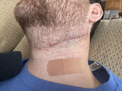 Diagnosed with 2 cancers in one month.