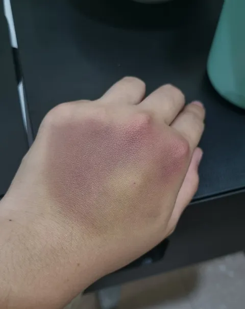 large bruising at my hand 2 days after a practice IV insertion