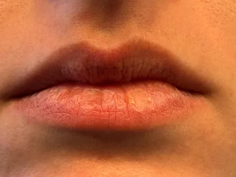 Chronically crusty lips 🥀 help