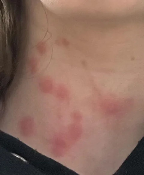The mosquito bites on my neck formed an ‘S’ shape