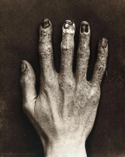 Hand belonging to an X-ray technician at the Royal London Hospital, showing damage caused by radiation exposure, 1900.