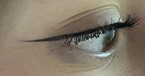 what is causing these black shadows under my eyes &amp; how to stop it?