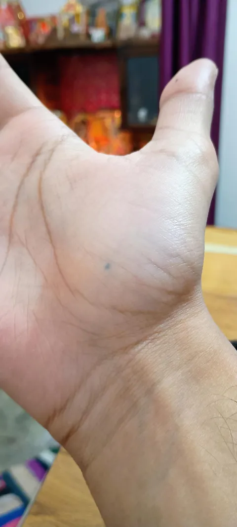 A pen's tip got stuck in my palm 5 years ago. The ink is still present under the skin.